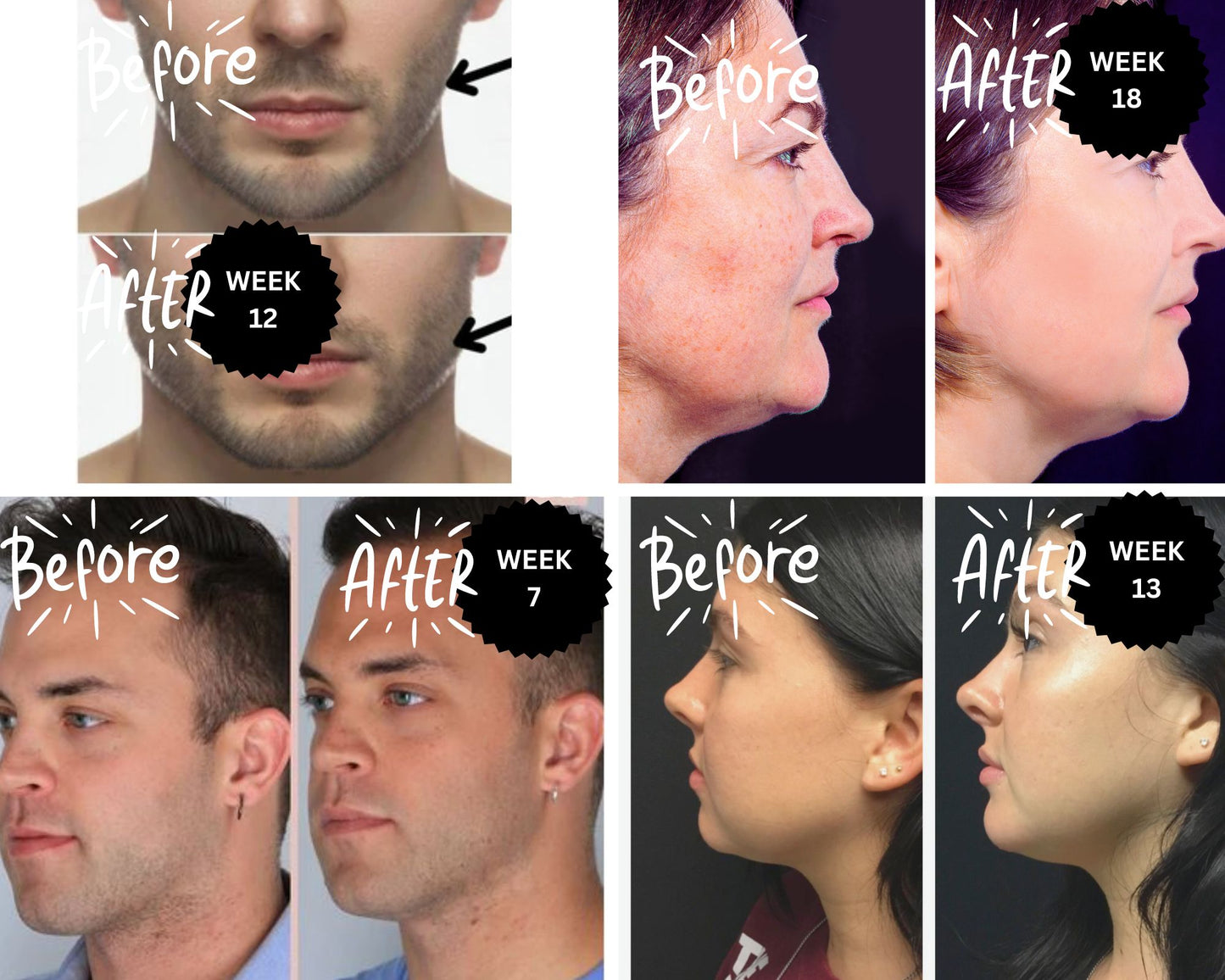 JawTone™ Jawline & TotalFACE Exerciser 2pc TOOLKIT - CHIN NECK CHEEKS JAW toning